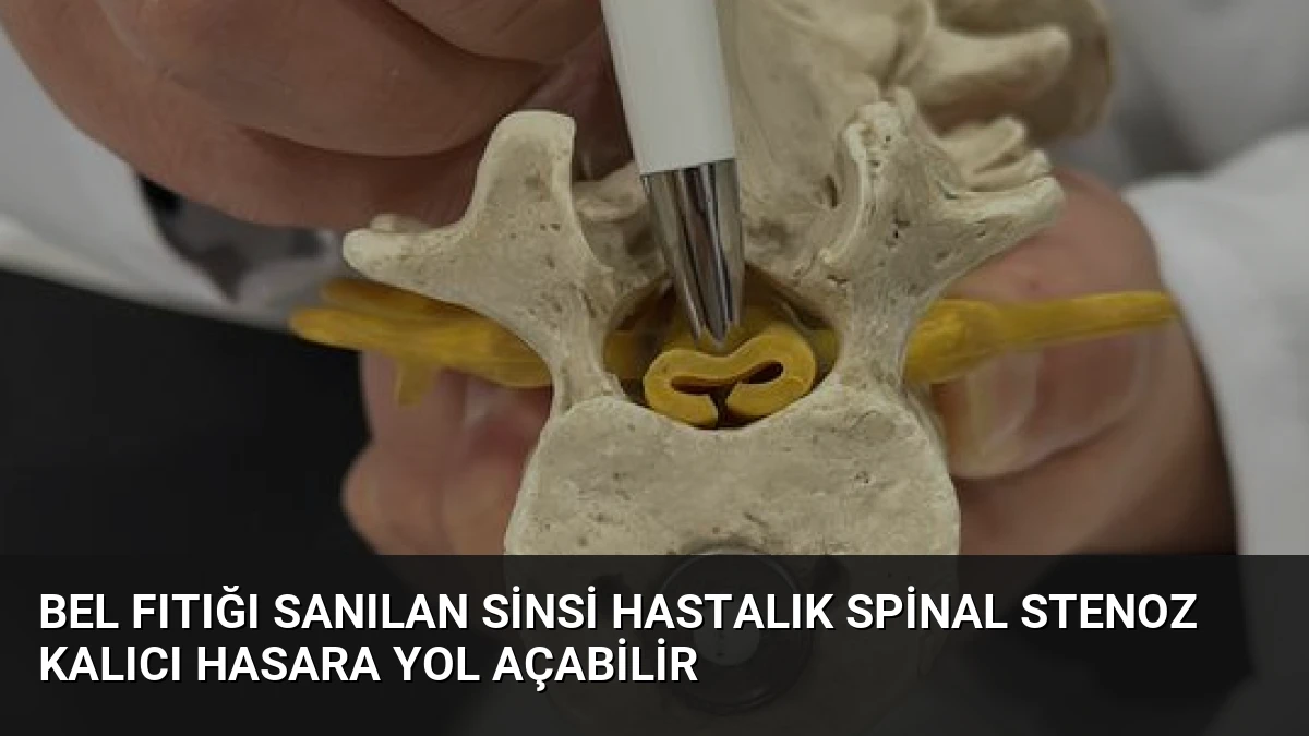 Bel Fıtığı Sanılan Sinsi Hastalık Spinal Stenoz Kalıcı Hasara Yol Açabilir