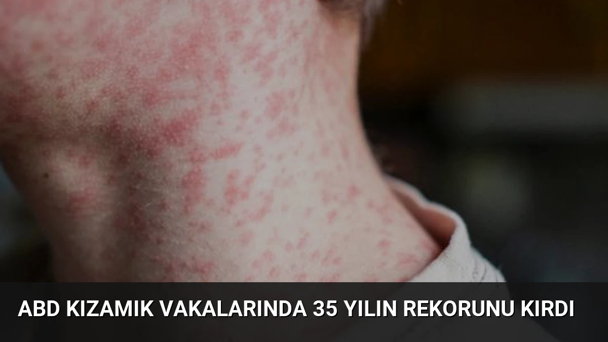 ABD Kızamık Vakalarında 35 Yılın Rekorunu Kırdı